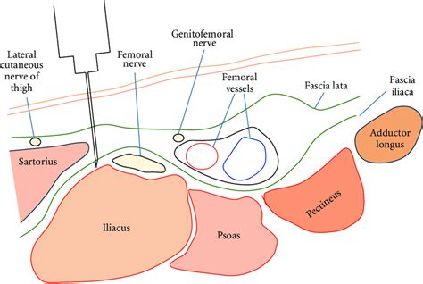 Fascia Iliaca Block Landmarks