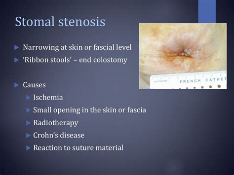 Stoma complications & its management