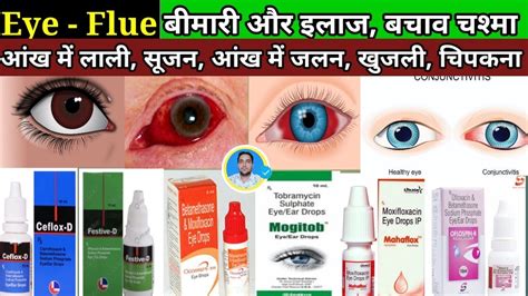 Eye Flue // Conjunctivitis //Eye Flue Treatment । Conjunctivitis ...