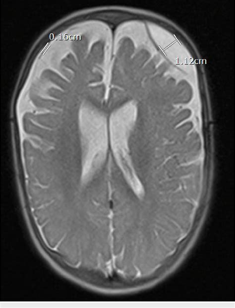 [PDF] A Subdural Hygroma Necessitating a Subdural-Peritoneal Shunt in a Pediatric Patient ...