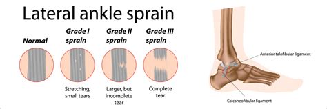 Is it a Sprain or a Strain – What’s going on with your Ankle Pain? - pt ...