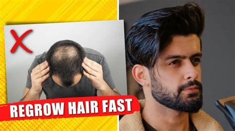 Top 48 image regrow hair for men - Thptnganamst.edu.vn