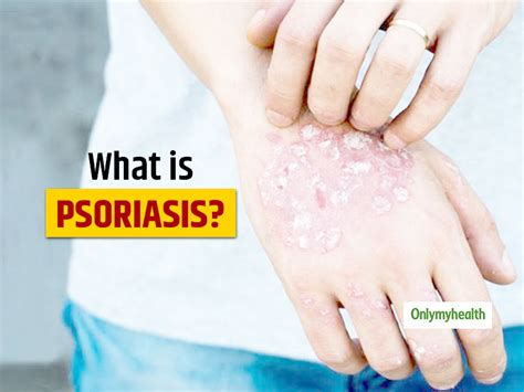 Psoriasis Rash Pictures Symptoms