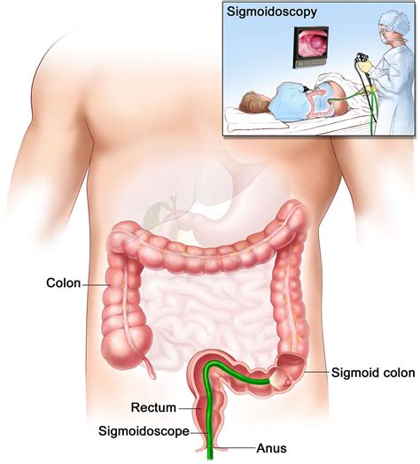 Sigmoidoscopy - Flexible, Rigid Sigmoidoscopy, Prep & Risks