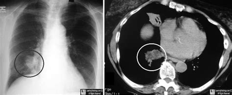 LearningRadiology - Lipoid Pneumonia