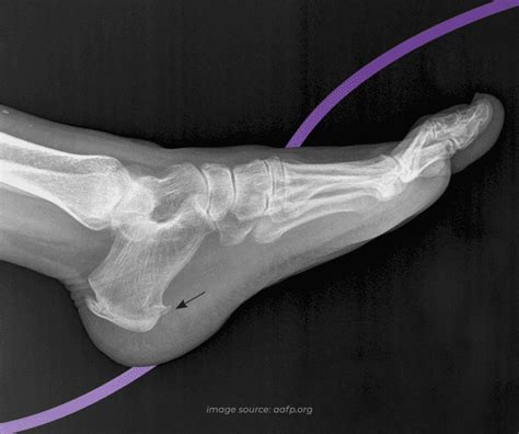 Heel Spur X Ray