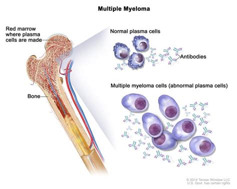 Bone Marrow Biopsy Results Multiple Myeloma - Brian Has Cancer