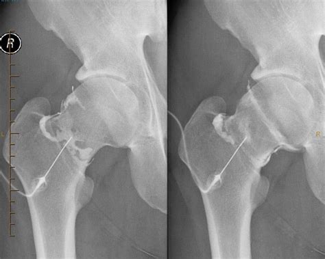 Hydrodilatation & Arthrography / Arthrogram Patient Guide