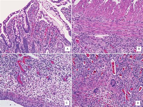 (A) Intestinal mucosa with nonspecific chronic inflammation. (B ...