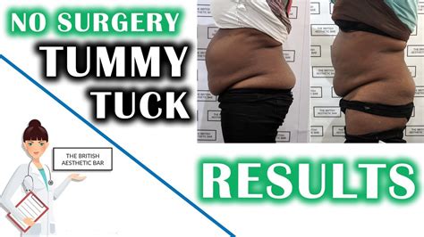 Belly Fat Reduction Without Surgery | Non Surgical Tummy Tuck in London | Full Procedure - YouTube