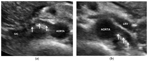 Inferior Mesenteric Artery Ultrasound