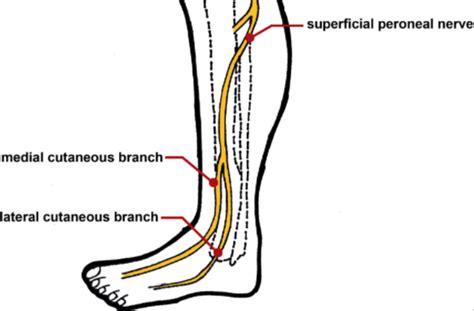 Superficial peroneal nerve injury in a professional runner: A case ...