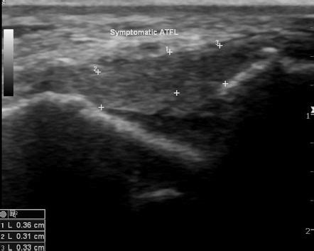 Lateral ankle sprain | Radiology Reference Article | Radiopaedia.org