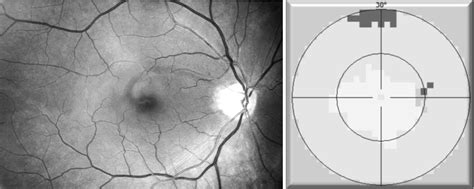 Nerve Fiber Layer Defects Imaging in Glaucoma | IntechOpen