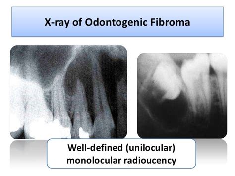 Odontogenic tumors