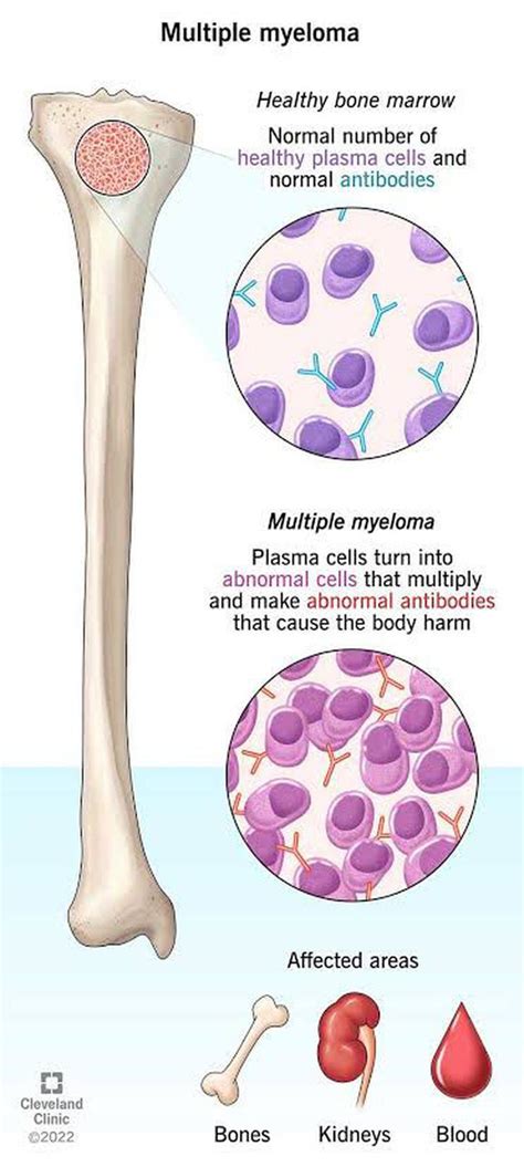 Multiple myeloma - MEDizzy