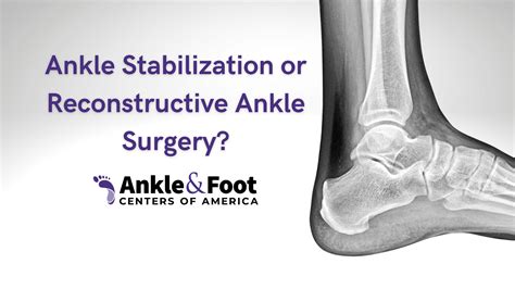 Ankle Stabilization Surgery | Ankle Ligament Reconstruction