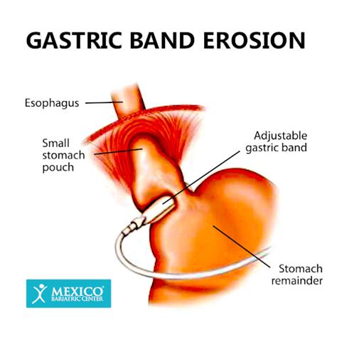 Gastric Banding (Lap-Band) Surgery Risks, Complications