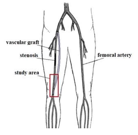 Proximal Superficial Femoral Vein