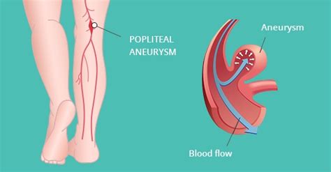 Popliteal Aneurysm - Nevada Vein And Vascular