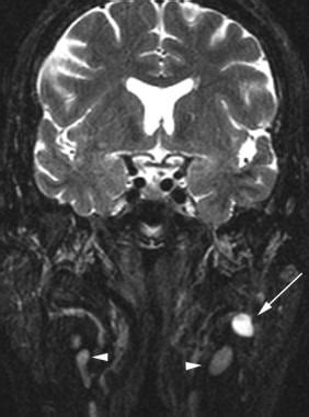 Pleomorphic Adenoma Imaging: Practice Essentials, Computed Tomography, Magnetic Resonance Imaging