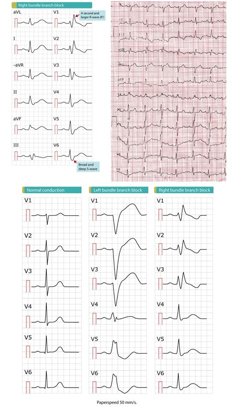 Right Bundle Branch Block (RBBB) Ecg Criteria - NCLEX Quiz