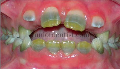 Green and Orange Stains on Teeth Due to Chromogenic Bacteria