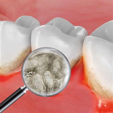 How Plaque Bacteria Can Cause Gum Disease | parodontax