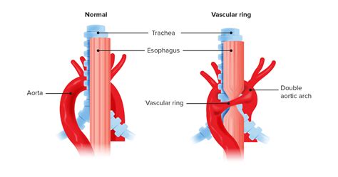 Vascular Rings | Concise Medical Knowledge