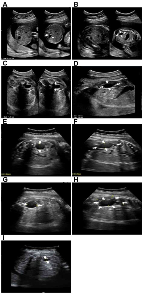 Hydronephrosis Grading Ultrasound