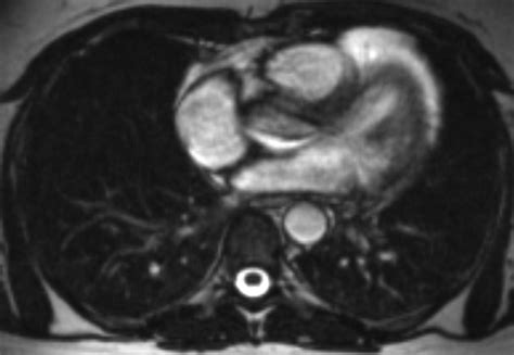 Acute Pulmonary Embolism to the Subsegmental Level: Diagnostic Accuracy ...