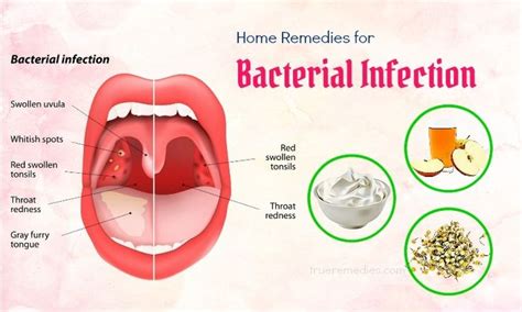 10 Best Home Remedies For Bacterial Infection In Throat | Bacterial infection, Infection in ...