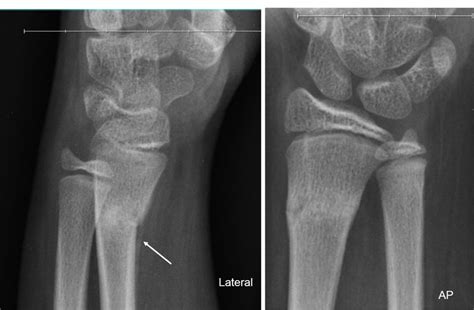 Torus fracture – Radiology Cases