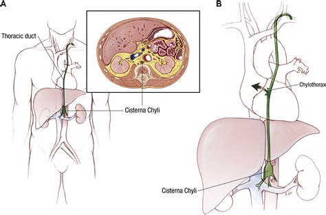 Treatment of Postsurgical Chylothorax - The Annals of Thoracic Surgery