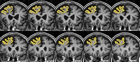 MRI volumetric measurement of right dorsolateral prefrontal cortex ...