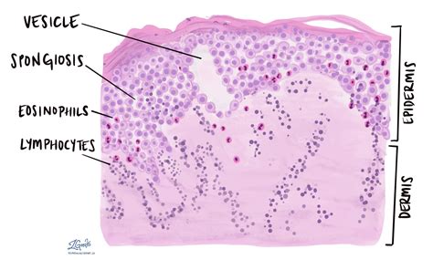 Spongiotic dermatitis - MyPathologyReport.ca