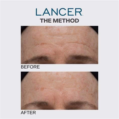 Lancer Skincare Review - Must Read This Before Buying