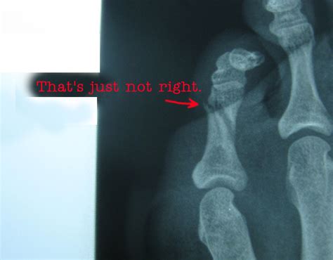 Broken Toe X-ray by NycterisA on DeviantArt