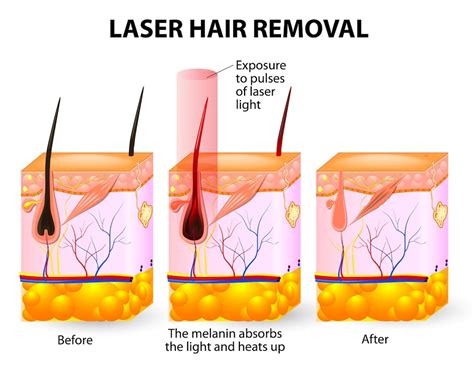 Laser Hair Removal Q&A – StrayHair