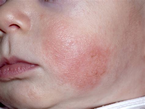 Childhood rashes, skin conditions and infections: photos - BabyCenter