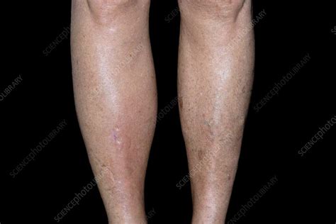 Post-thrombotic syndrome - Stock Image - C023/4314 - Science Photo Library