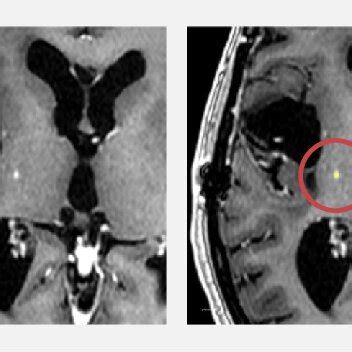 Example of punctate contrast-enhancing (CE) tumour lesion on... | Download Scientific Diagram