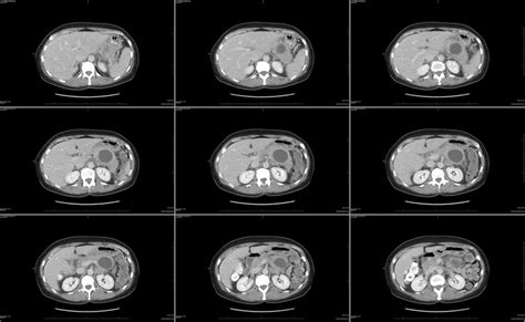 What is a Pancreas CT scan? | Two Views