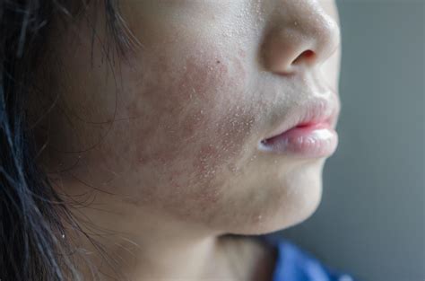 rash face woman allergic to cosmetics food allergy or air allergy ...