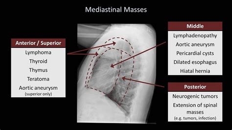 How to Interpret a Chest X-Ray (Lesson 5 - Cardiac Silhouette and ...