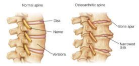 Bone Spur Spine Pain and Treatments | AllSpine