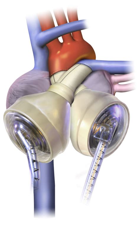 Saint Thomas announces first total artificial heart program in ...