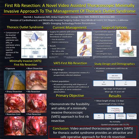 First Rib Resection: A Novel Video Assisted Thoracoscopic Minimally Invasive Approach to the ...