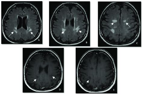 Case III. (A-C) Axial T2/FLAIR brain MRI shows periventricular... | Download Scientific Diagram