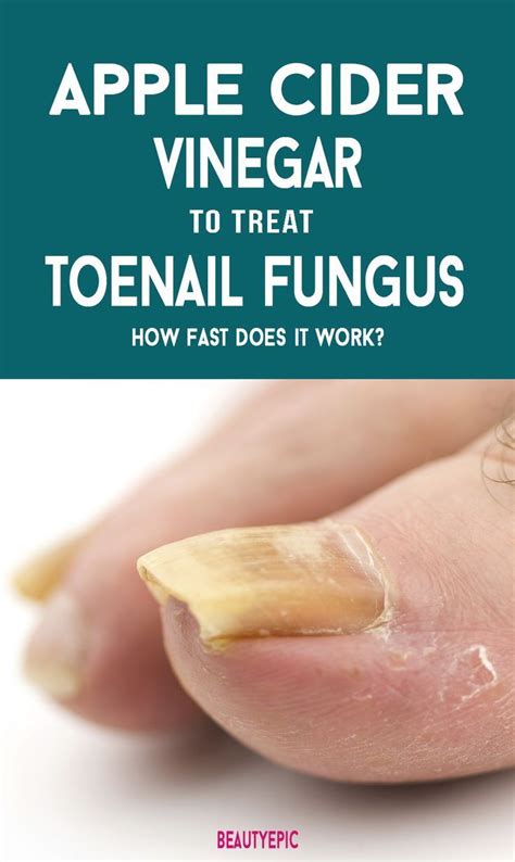 Apple Cider Vinegar For Toenail Fungus | Apple cider vinegar remedies, Toenail fungus remedies ...